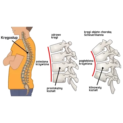 dziecieca-orteza-tulowia-prostujaca-plecy-ampes01 (3).webp