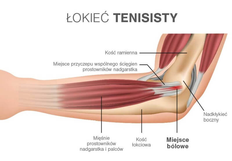 łokieć tenisisty